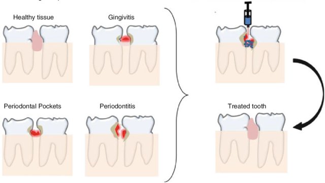 Nanomaterials-in-the-treatment-of-periodontal-diseases-Various-stages-of-periodontal_W640